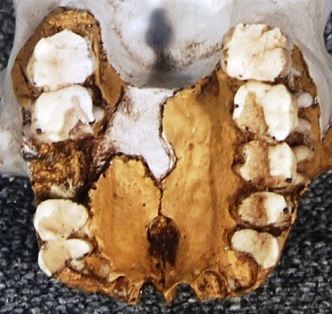 Stw 53 Homo gautengensis dentición