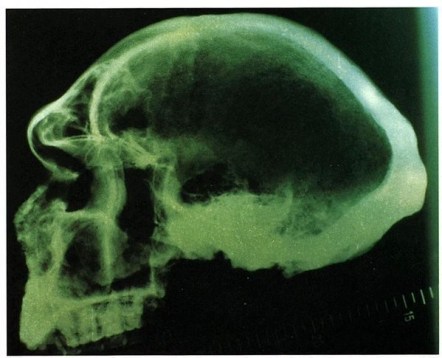 Radiograph Petralona