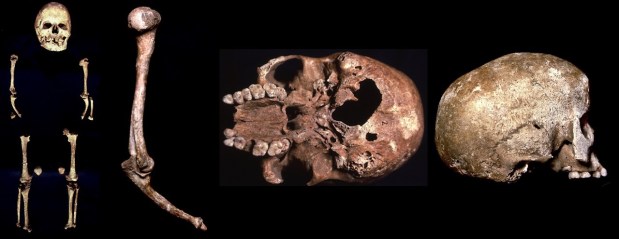 Romito 2: un caso de enanismo en el Paleolítico superior estudiado con la Bioarqueología del&nbsp;Cuidado